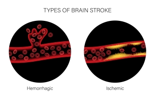 Types of Brain Strokes